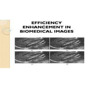 "ECG Signal Noise Reduction Using Adaptive Filtration for Efficient Signal Enhancement"