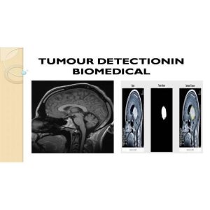 Brain Tumor Detection Using Edge Detection Technique